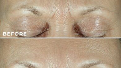 This treatment has users saying their fine lines are 'practically erased' — and it's needle-free