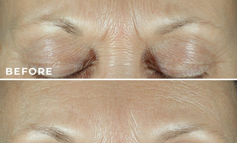 This treatment has users saying their fine lines are 'practically erased' — and it's needle-free